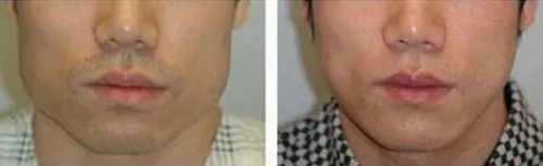 怎样改变脸部过敏_怎样消除脸部松弛