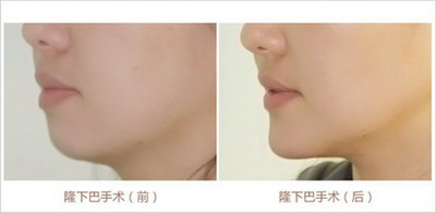 脸上突然长了好多痣_脸上几天突然长了好多痘