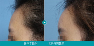 做个面部拉伸多少钱