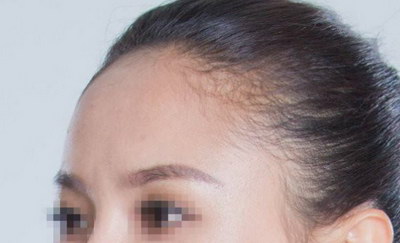 咬肌大是怎么造成的(了解咬肌大)