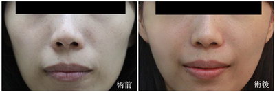破尿酸填充泪沟靠谱吗(什么是破尿酸填充泪沟？)