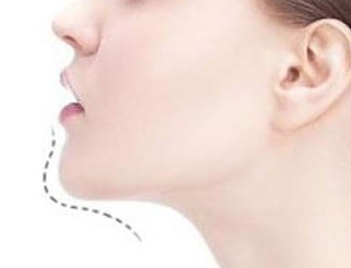 小v脸是怎么做的_什么是小v脸提升针