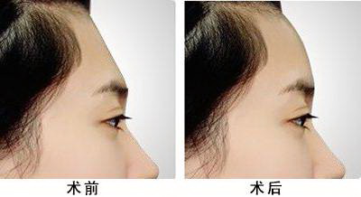 有什么办法可以去脸上的皱纹_打了除皱针三天还有皱纹是不是没有打好