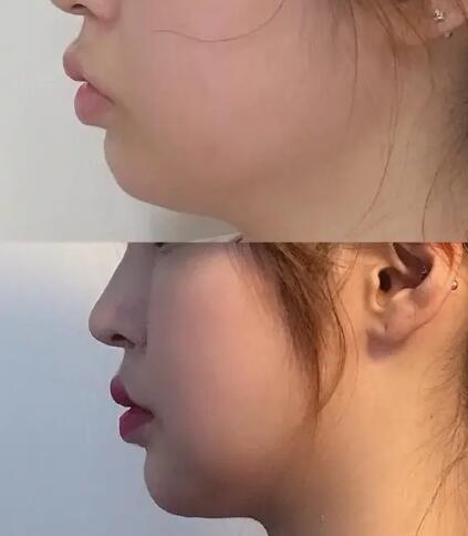 易经女额头凹陷上面突_按摩能去除额头皱纹吗