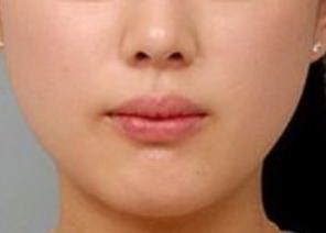 面部拆线后多久可以洗澡_面部提升美容图片