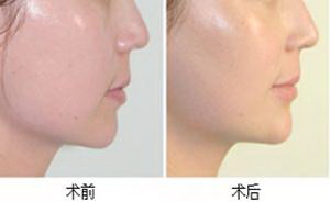 脸上长痘吃什么蔬菜(脸上长痘怎么办？)