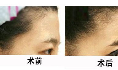 脂肪填充额头费用多少「自体脂肪填充额头费用」