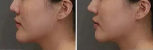 脸部颧骨高矫正手法(颧骨高的问题)