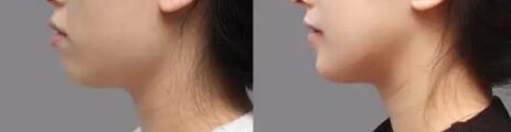 宝宝牙齿地包天会有什么影响(宝宝牙齿地包天挂什么科?)