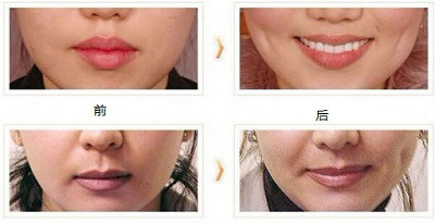 脂肪填充脸部后吃什么对脂肪存活好[脂肪填充脸部应该注意什么]