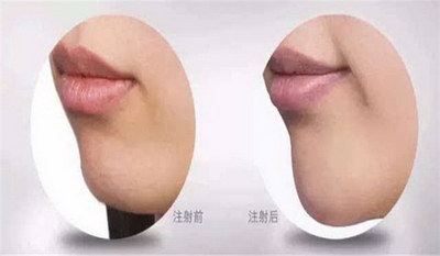 如何祛除脸部色斑