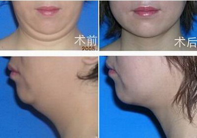 脸的下颚骨太宽怎么办_磨下颚骨脸部会松弛下垂吗