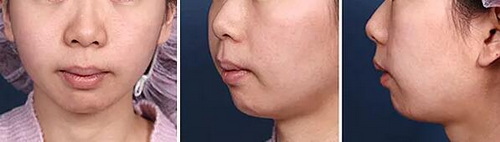 戴美容面罩脸上要涂什么