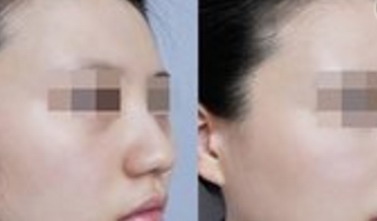 才34岁脸上皱纹皮松了_断纹液去皱纹效果如何