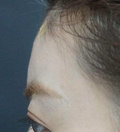 面部经络不通怎么治疗_面部提升美容医院