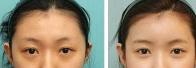 脂肪填充额头费用多少「自体脂肪填充额头费用」