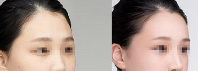 下巴长痘怎么调理得快