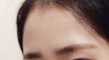 避免酒窝成形术后口腔感染的几个要点