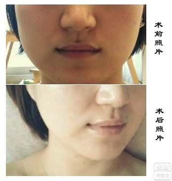 脂肪填充太阳穴凹陷能维持多久(填充太阳穴凹陷，效果能够维持多久？)