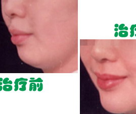 脸部突然长痣怎么回事(突然长痣，这是怎么回事？)