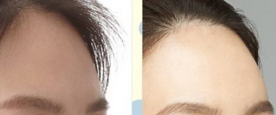 人中长火疖子怎么消除(人中长火疖子怎么办)