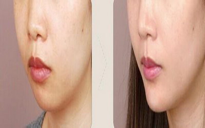自体脂肪填充泪沟可以保多久(自体脂肪填充泪沟多久可以成活)