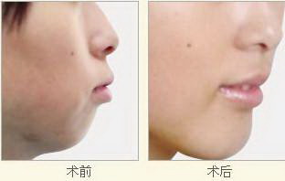 脸上有毛孔是为什么(为什么会在脸上有毛孔)
