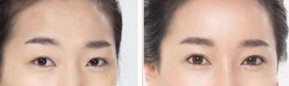 脸上的雀斑能去掉吗(脸上的雀斑咋去掉)