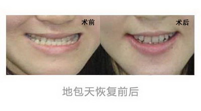 额头填充硅胶是永久的么(硅胶填充额头副作用)