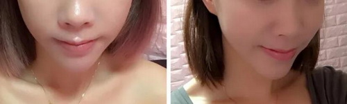 怎样快速消除面部过敏如何处理
