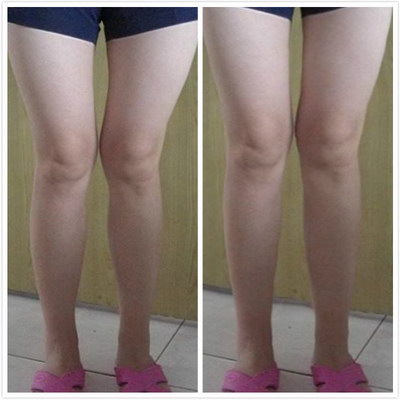 手术矫正o型腿哪家医院好(手术o型腿矫正哪家医院好)