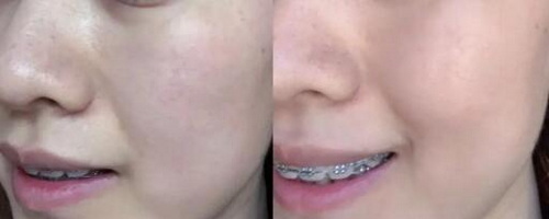 为什么不挤痘痘还会留下红印[为什么挤痘痘会留下痣]