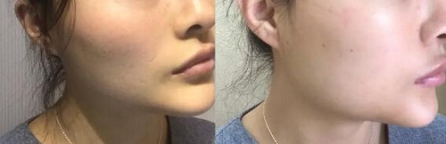 果酸换肤好还是美白