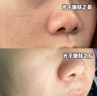 长了青春痘能吃海鲜吗？