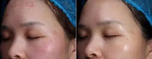 如何消除脸上雀斑(脸上的雀斑如何消除)