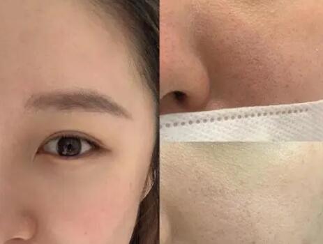 胎记多大年龄去除最好