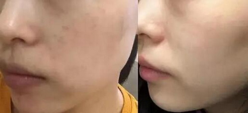 如何治疗脸上黄褐斑？