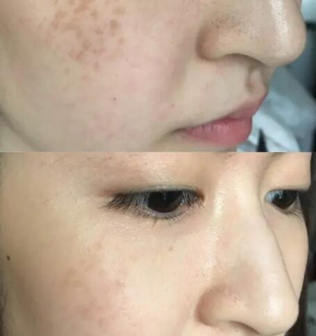 脸上长痘是缺什么(脸上长痘痘是缺什么)