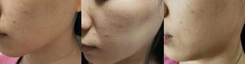 激光祛斑反黑印子怎么去除(什么是激光祛斑和反黑印子？)