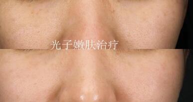 打完瘦脸针皮肤松弛会恢复么(打完瘦脸针皮肤松弛怎么办)