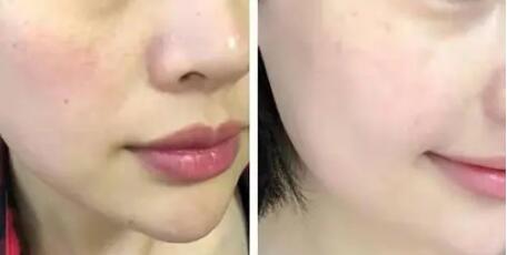 雀斑怎么如何快速去掉
