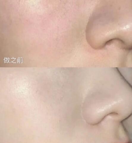 皮肤下垂松弛有法令纹用哪些医美