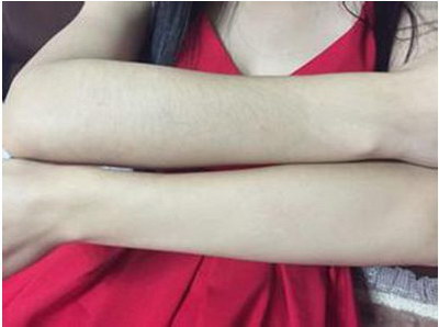 手臂脱毛什么方法好呢？