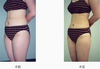 吸脂手术多少天恢复(肚子吸脂手术多少天能恢复)