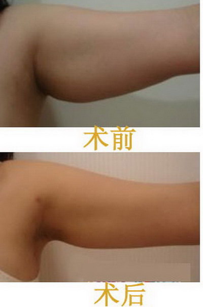 手臂吸脂大概多少钱