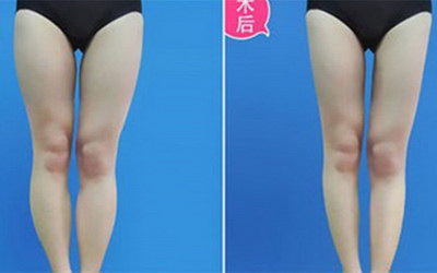 腿部吸脂后可以走路吗(腿部吸脂多久可以走路)