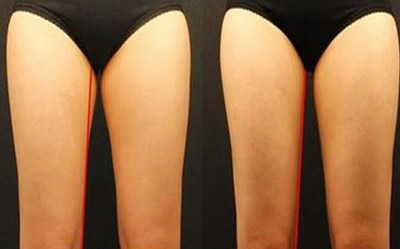 大腿吸脂能让大腿变长吗?看起来修长而已要多少钱？