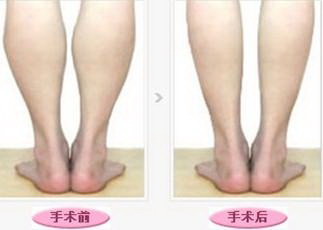 简单瘦大腿运动(瘦大腿的简单运动)