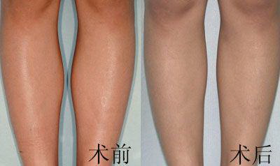 如何消耗大腿脂肪_大腿上有红色的肥胖纹