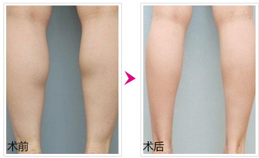 女生瘦腿最有效运动什么呀？
